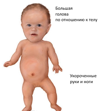 Ахондроплазия – причины симптомы и лечение